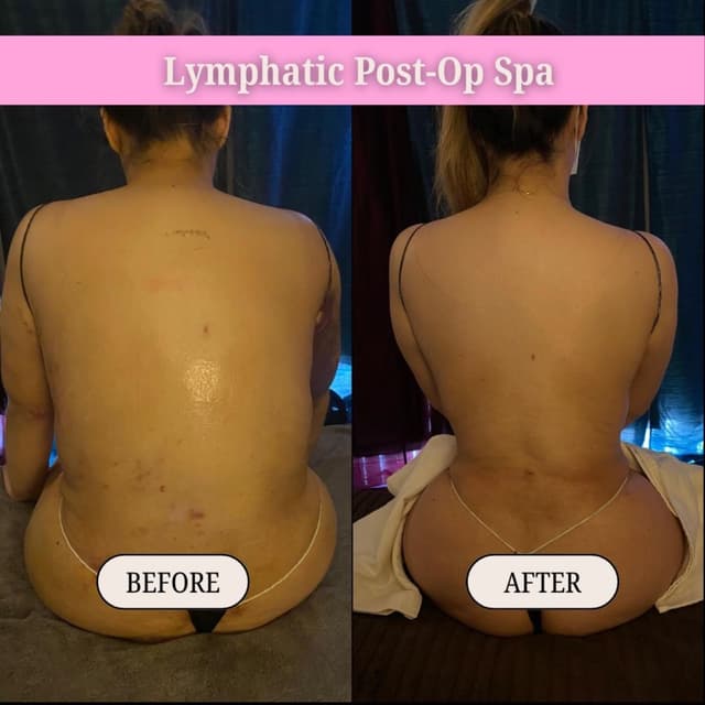 10 Post-Op Lymphatic Drainage at Lymphatic Post-Op Spa in San Diego, CA