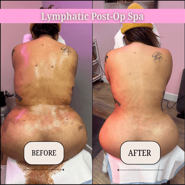 15 Post-Op Lymphatic Drainage at Lymphatic Post-Op Spa in San Diego, CA