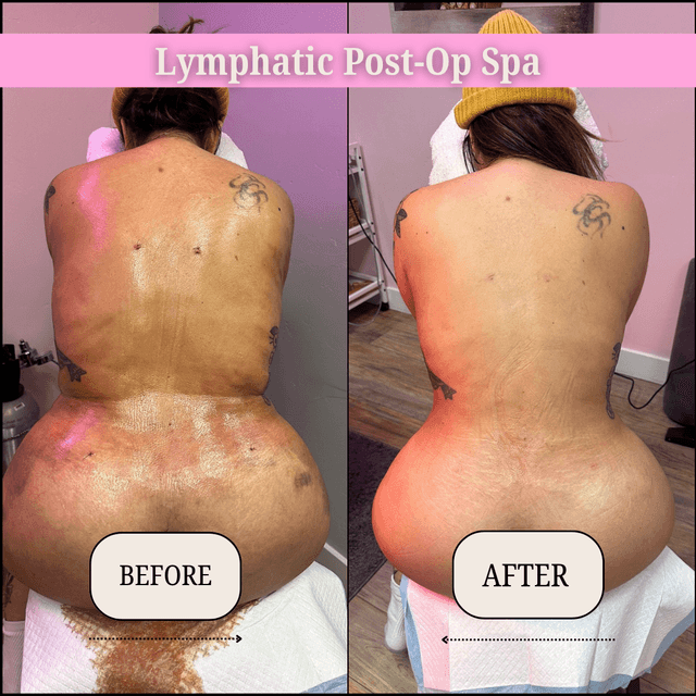 8 90 min Post-Op lymphatic Drainage at Lymphatic Post-Op Spa in San Diego, CA